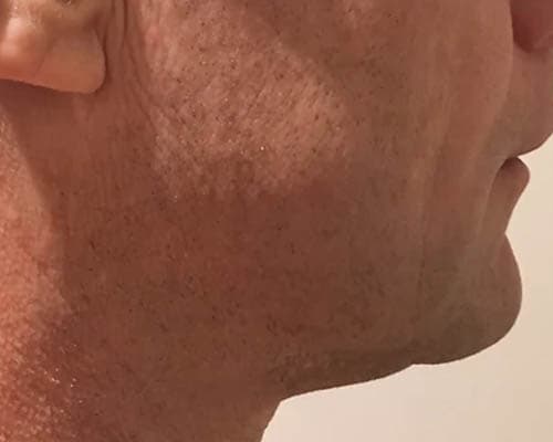 After HIFU treatment 2