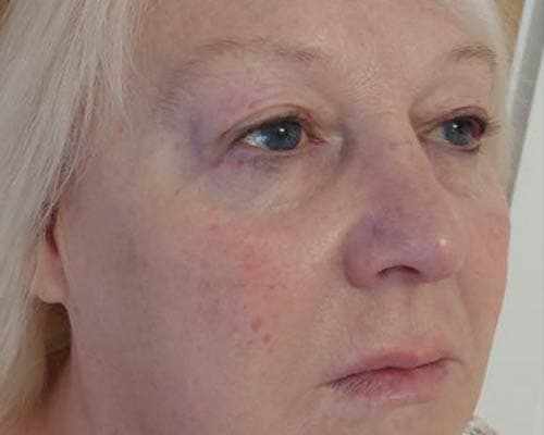 After HIFU treatment 3