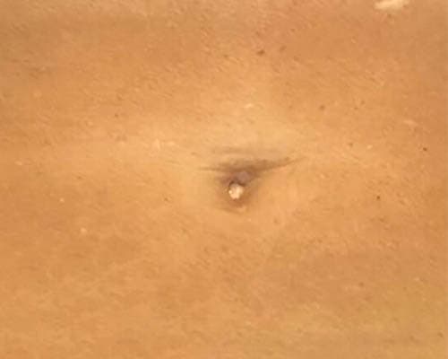 After HIFU treatment 4