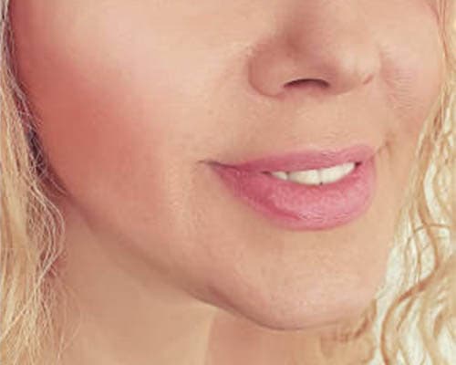 After HIFU treatment 1