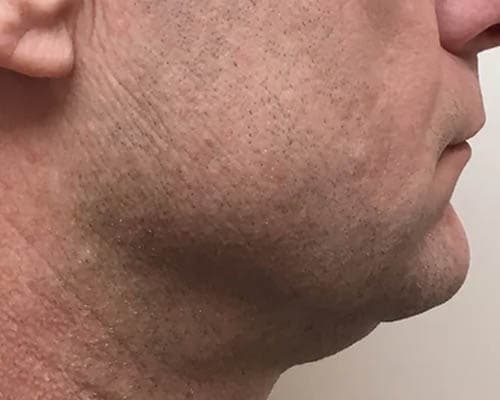 Before HIFU treatment 2