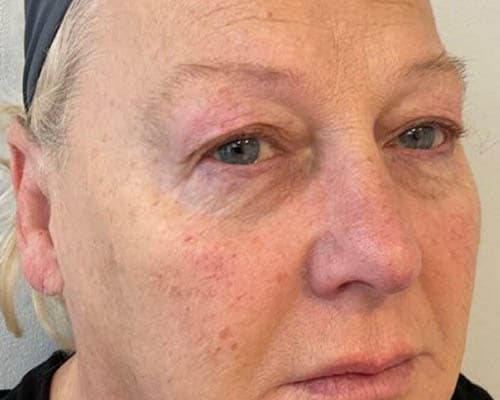 Before HIFU treatment 3