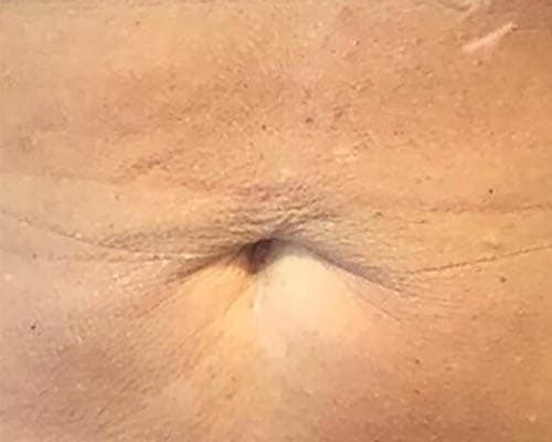 Before HIFU treatment 4