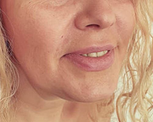 Before HIFU treatment 1